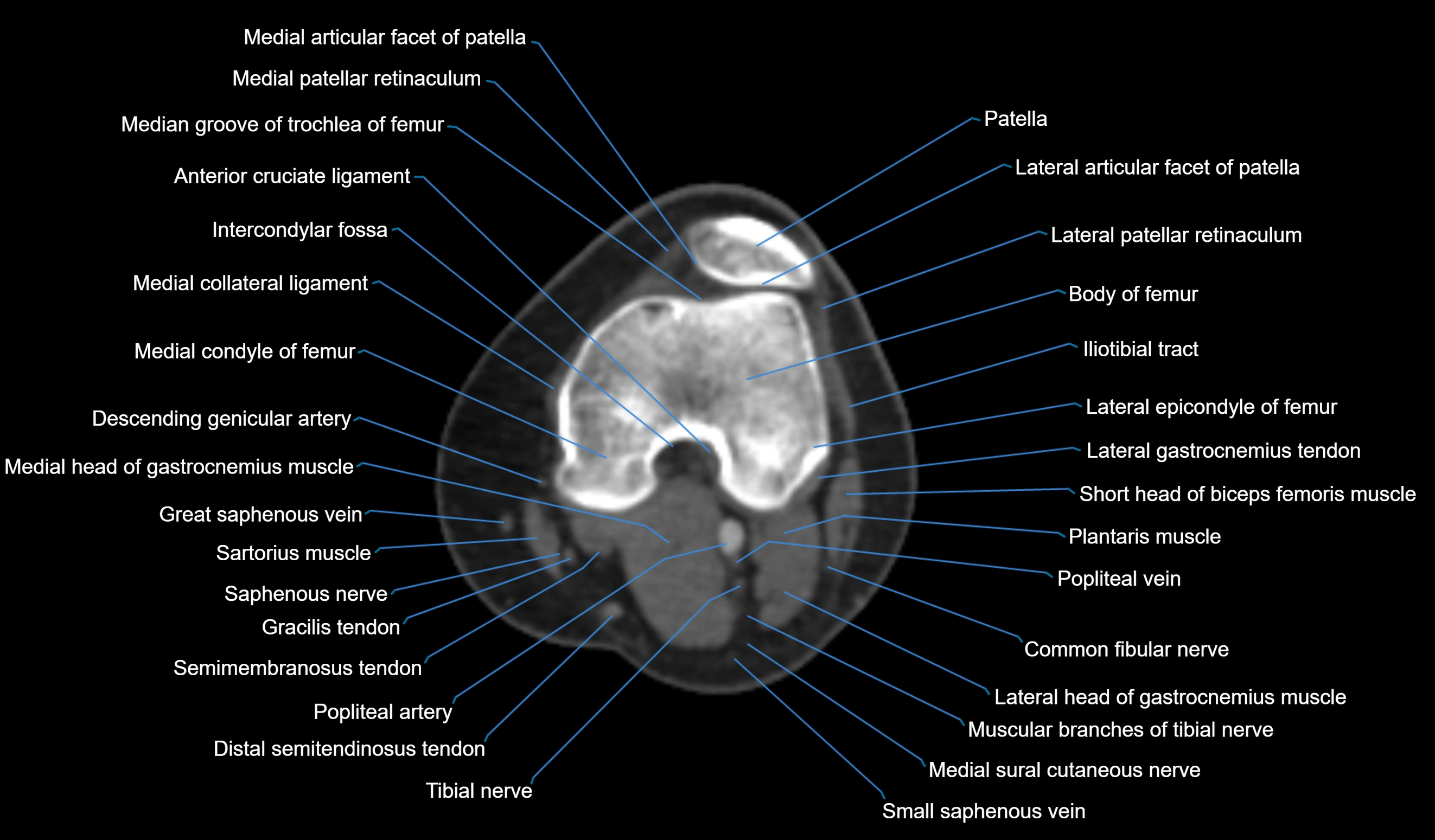 CT knee axial cross sectional anatomy labelled image-00027.webp
